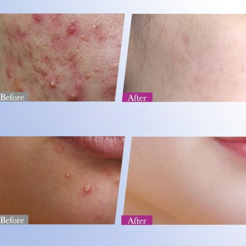 7/10/14Pcs Colorful Star Acne  - Skincare Qv recensione e prezzo