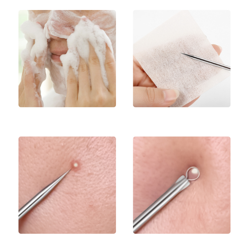 4pcs/set Acne Removal Needles  - Skincare Qv recensione e prezzo