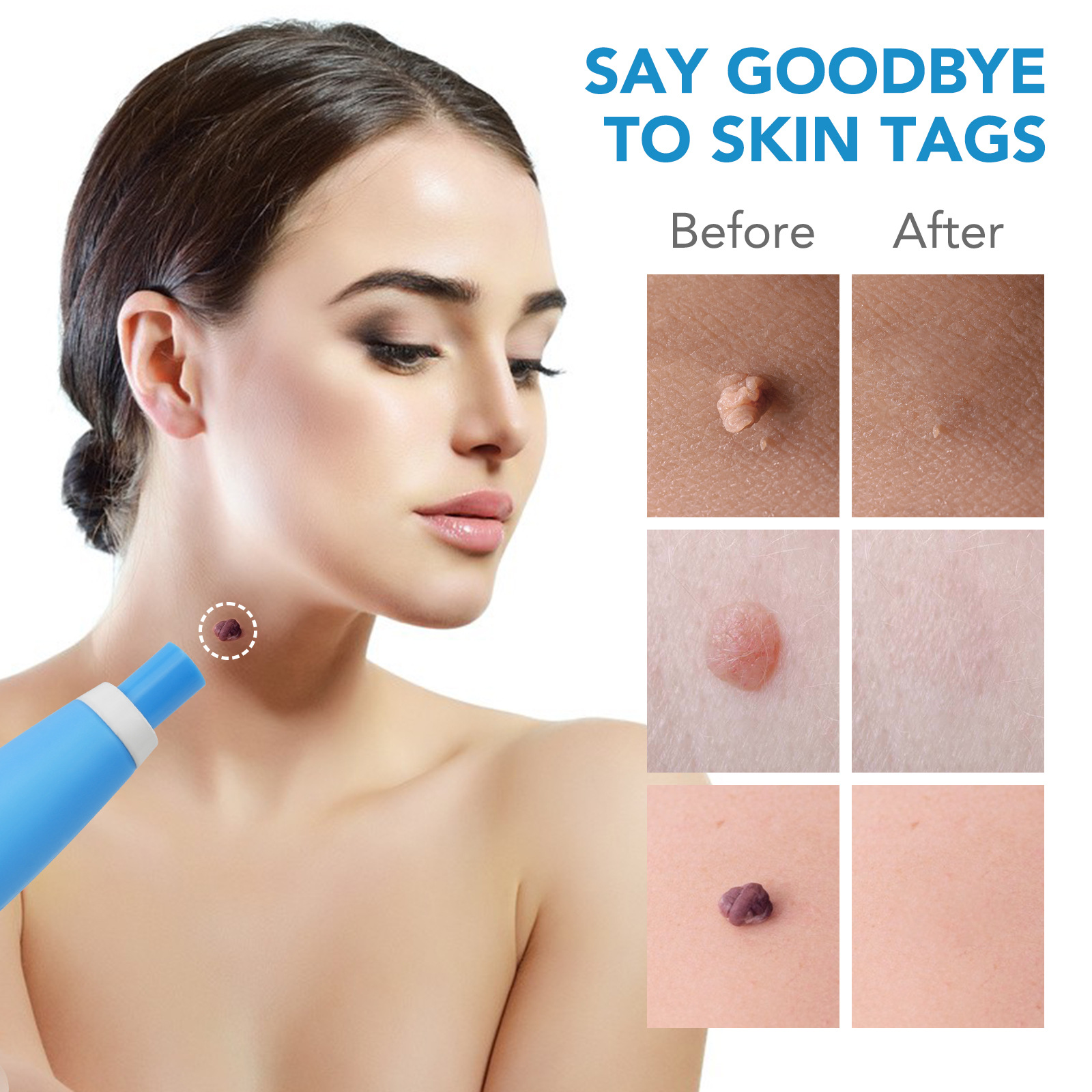 2 IN 1 Auto Skin Tag Remover K - Skincare Qv recensione e prezzo